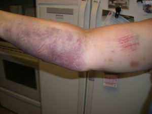 bruised-arm1